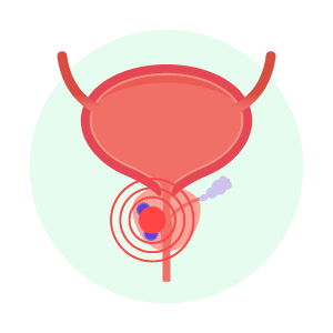 Prostate cancer